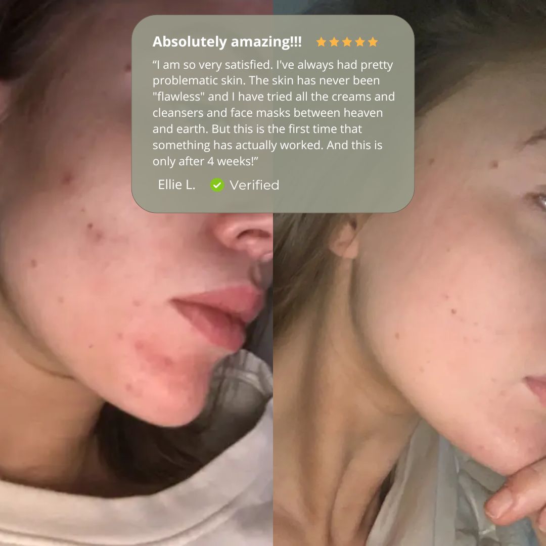 Acnetane | Get rid of stubborn Acne | 60 Capsules